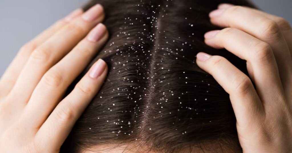 Dandruff Causes, Symptoms, and Solutions
